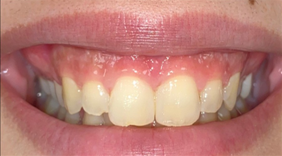 بعد تجميل وعلاج اللثة مركز دكتور ايمن الغمراوى لطب الاسنان 5